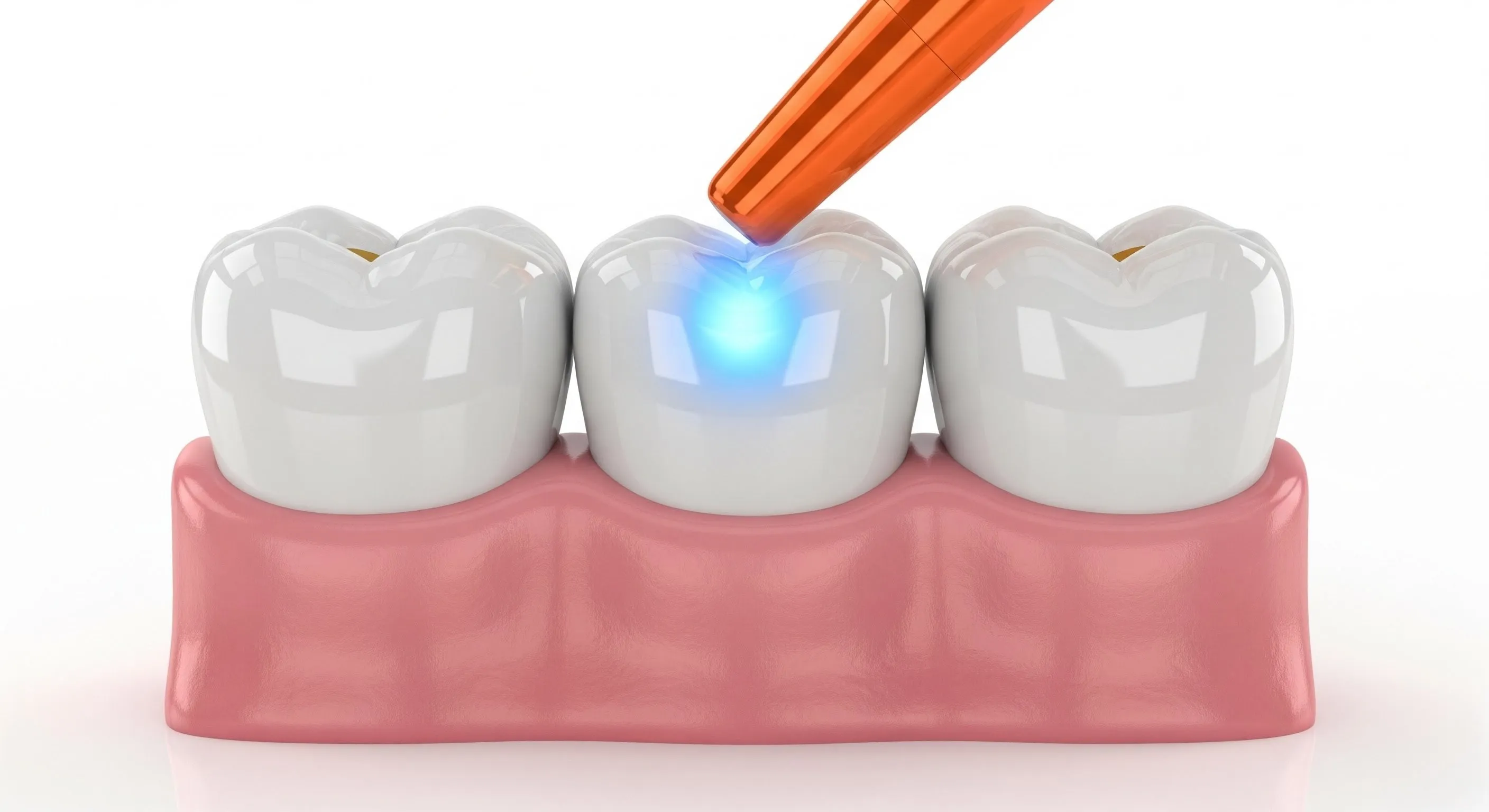Composite Fillings Cost and Pricing Information in Edgewater